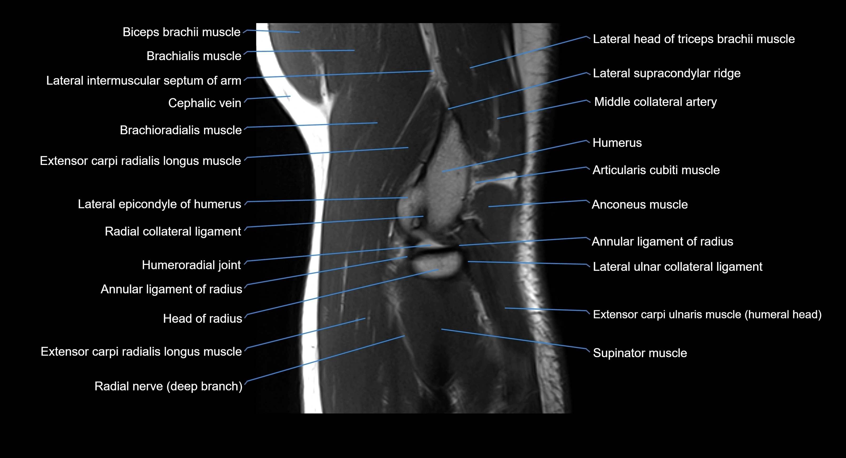 MRI elbow joint  sagittal cross sectional anatomy 3T  radiology  image-img-00001-00019.webp
